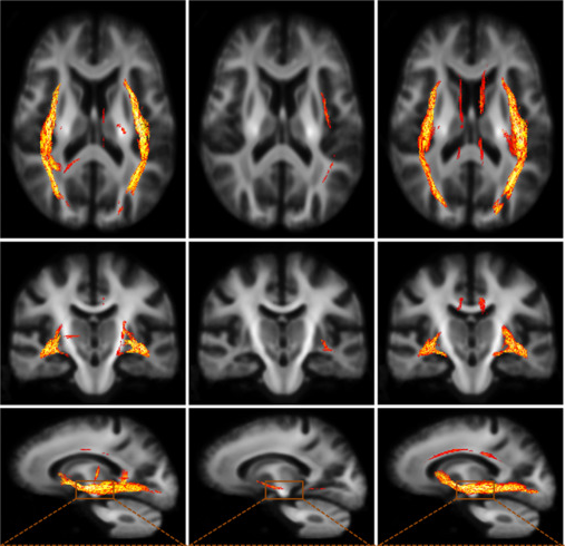New imaging technique provides insight into multiple sclerosis