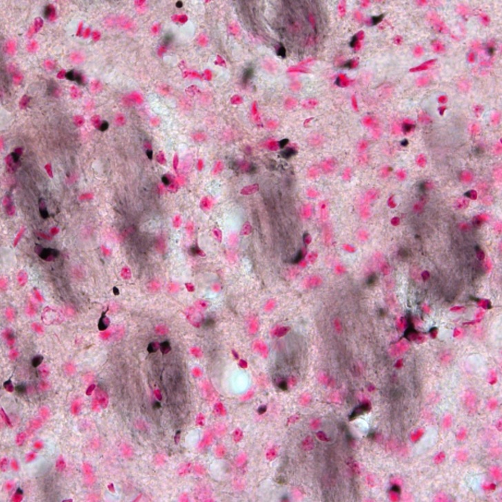 Targeting brain iron in Multiple System Atrophy offers therapeutic potential finds new study