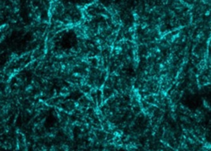 Brain scan showing myelin in a brain affected by motor neurone disease. 