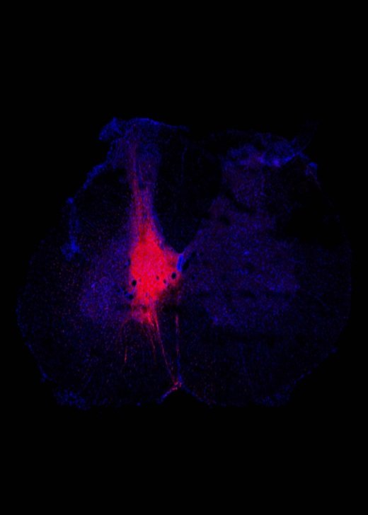 Intraspinal lumbar injection of human pluripotent stem cells stained for RFP (Red) with DAPI (blue). Credit: Raoul Das.