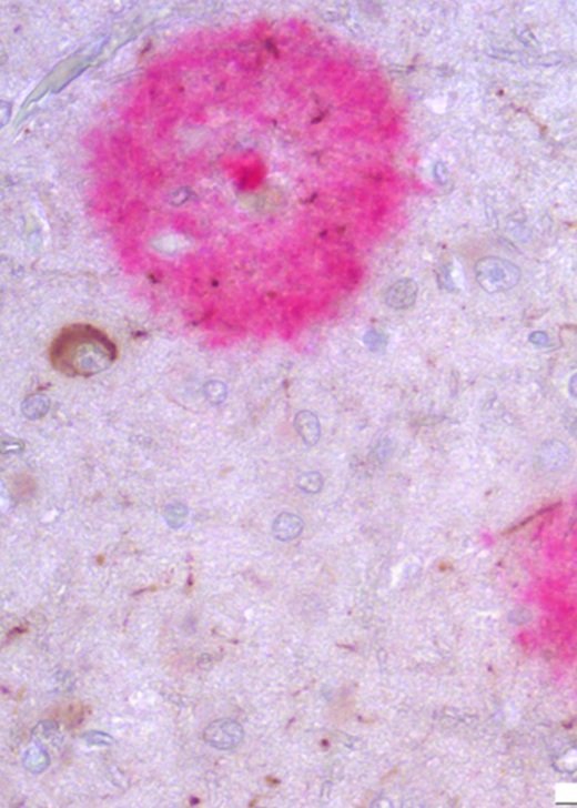 Microscopic image of Alzheimer's disease pathology
