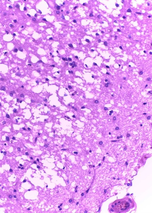 Haematoxylin and eosin stained section of brain cortex showing a pink sponge-like texture with holes and dark pink spots.