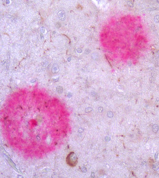 Alzheimer’s disease pink amyloid