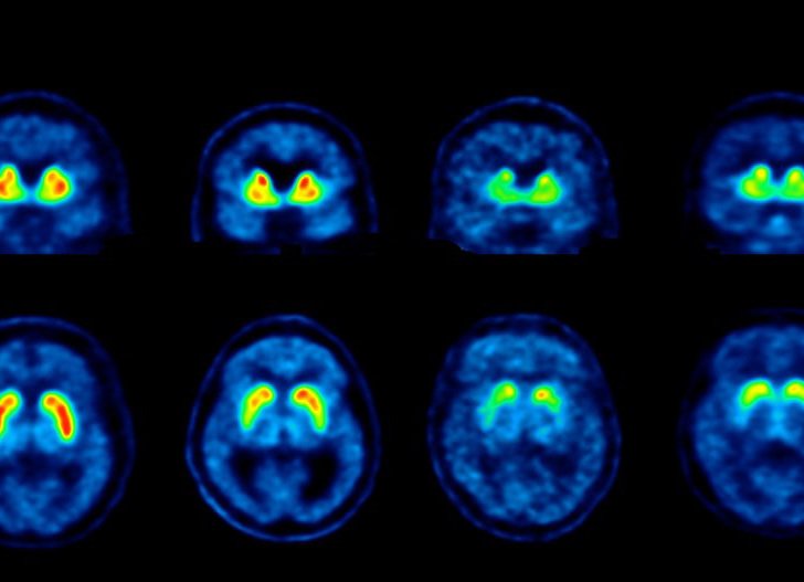 PET scans of four brains: a healthy control, a person with REM behaviour disorder, a person with dementia with Lewy bodies, and a person with Parkinson's disease. Image courtesy of Austin Health.