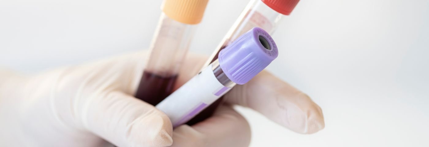 Blood test for diagnosing Alzheimer’s disease