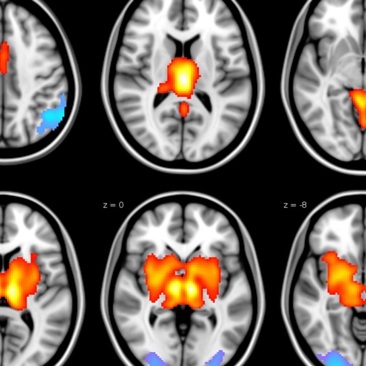 EEGfMRI imaging