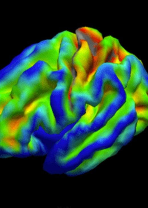 MRI scan of a brain showing vivid blue, green and red cololours against a black background.