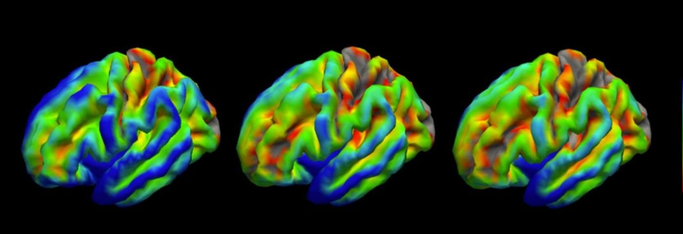 How fast is your brain ageing scan