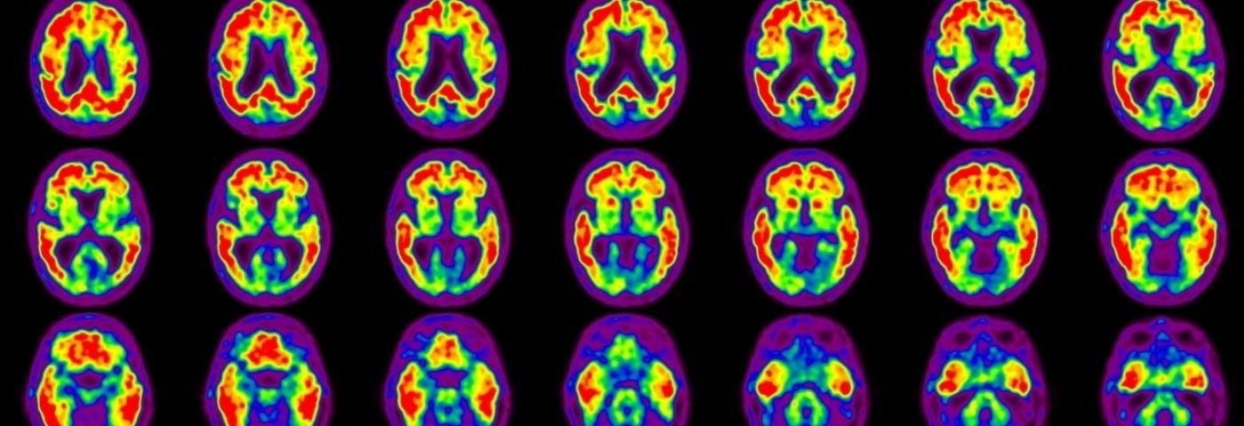 PET scan of brain showing red sections, indicating increased brain amyloid.