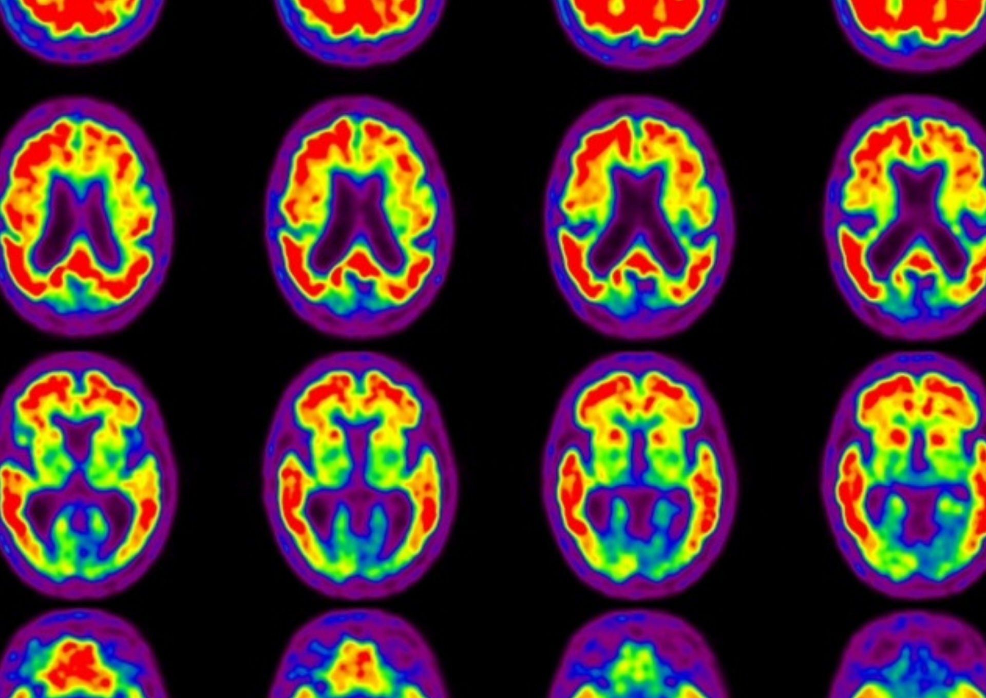 Brain PET scan shows red sections, indicating increased brain amyloid.