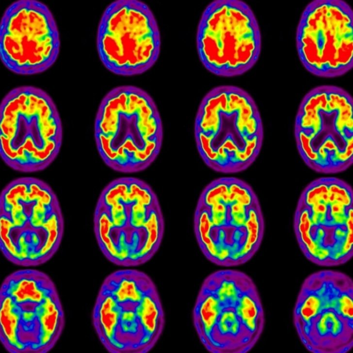 Brain PET scan shows red sections, indicating increased brain amyloid.