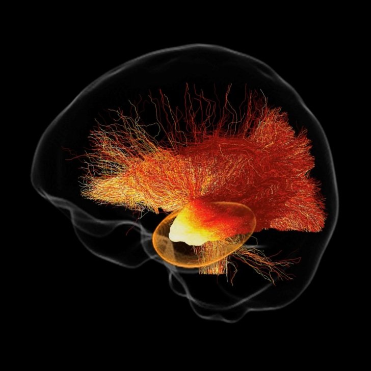 Brain scan