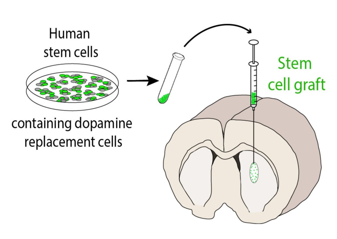 Diagram showing stem cell therapy process