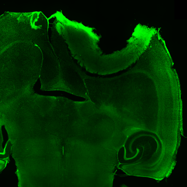 Cortex Interrupted: A Tumour’s Presence in the Path of Thought