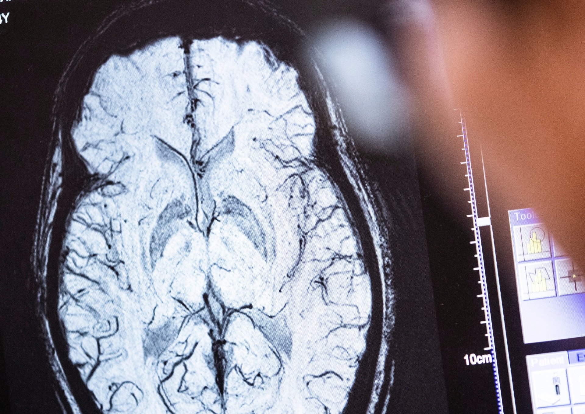 MRI brain scan