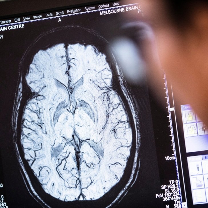 MRI brain scan