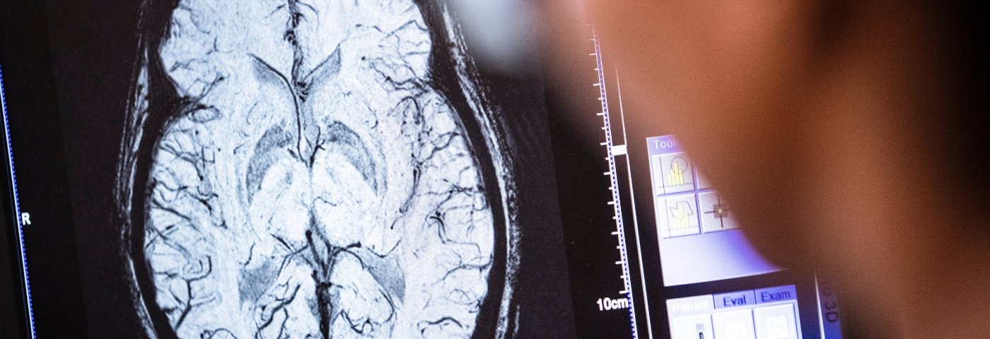 MRI brain scan